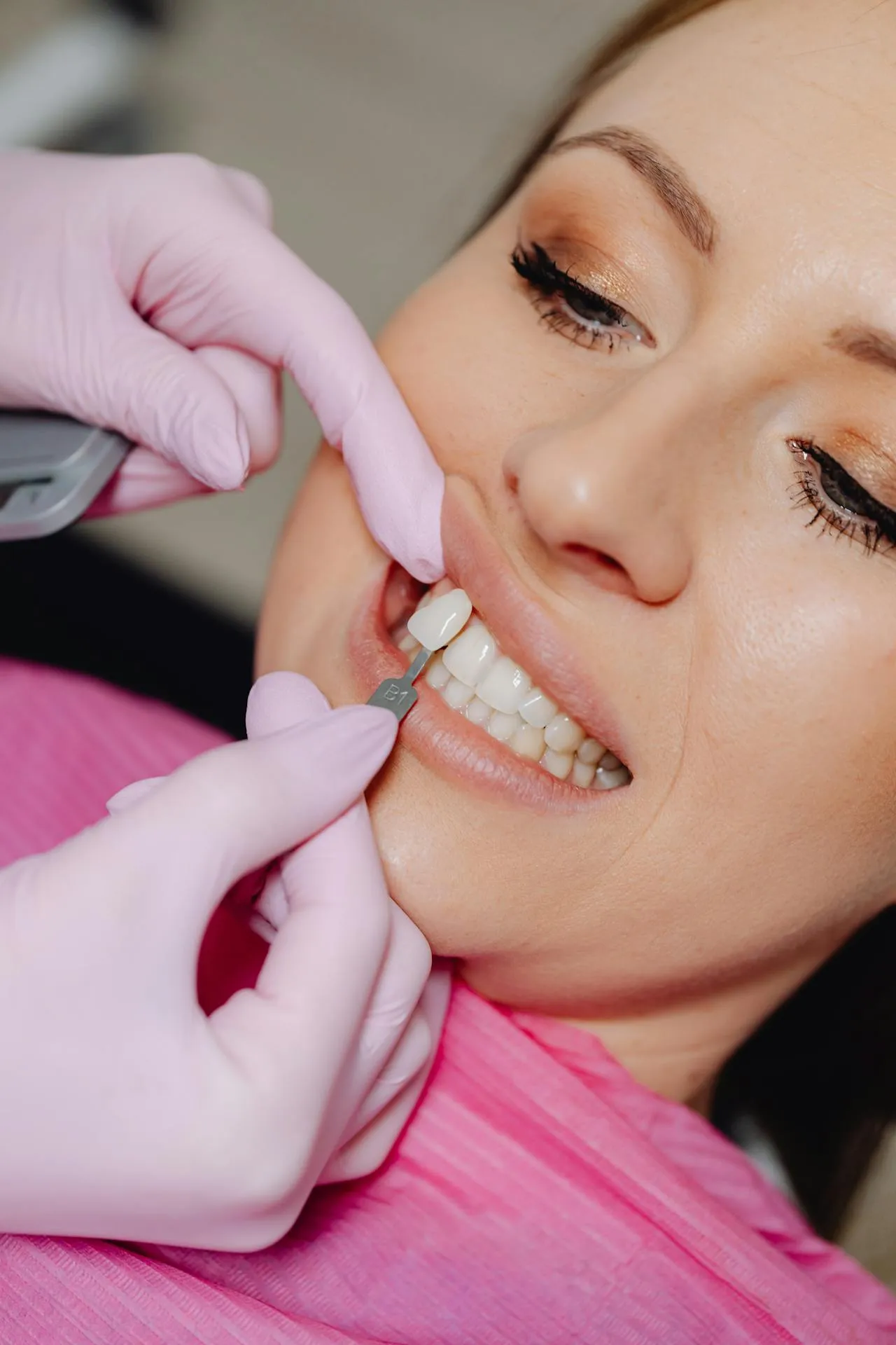 Hollywood smile design procedure in progress at an Antalya dental clinic — digital smile design and cosmetic planning